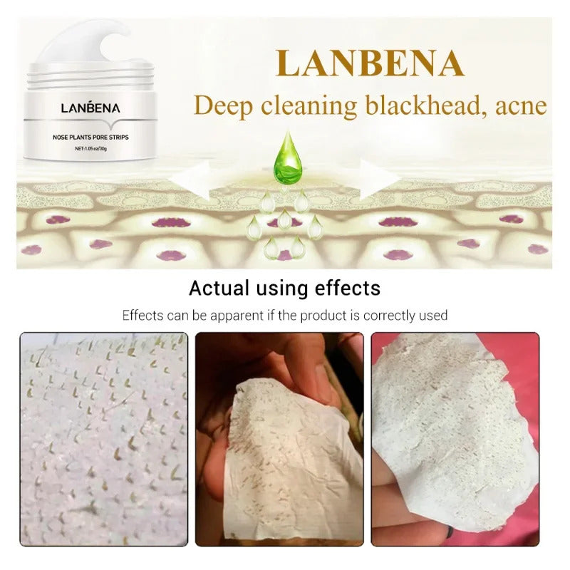 Blackhead Remover Cream & Pore Strips