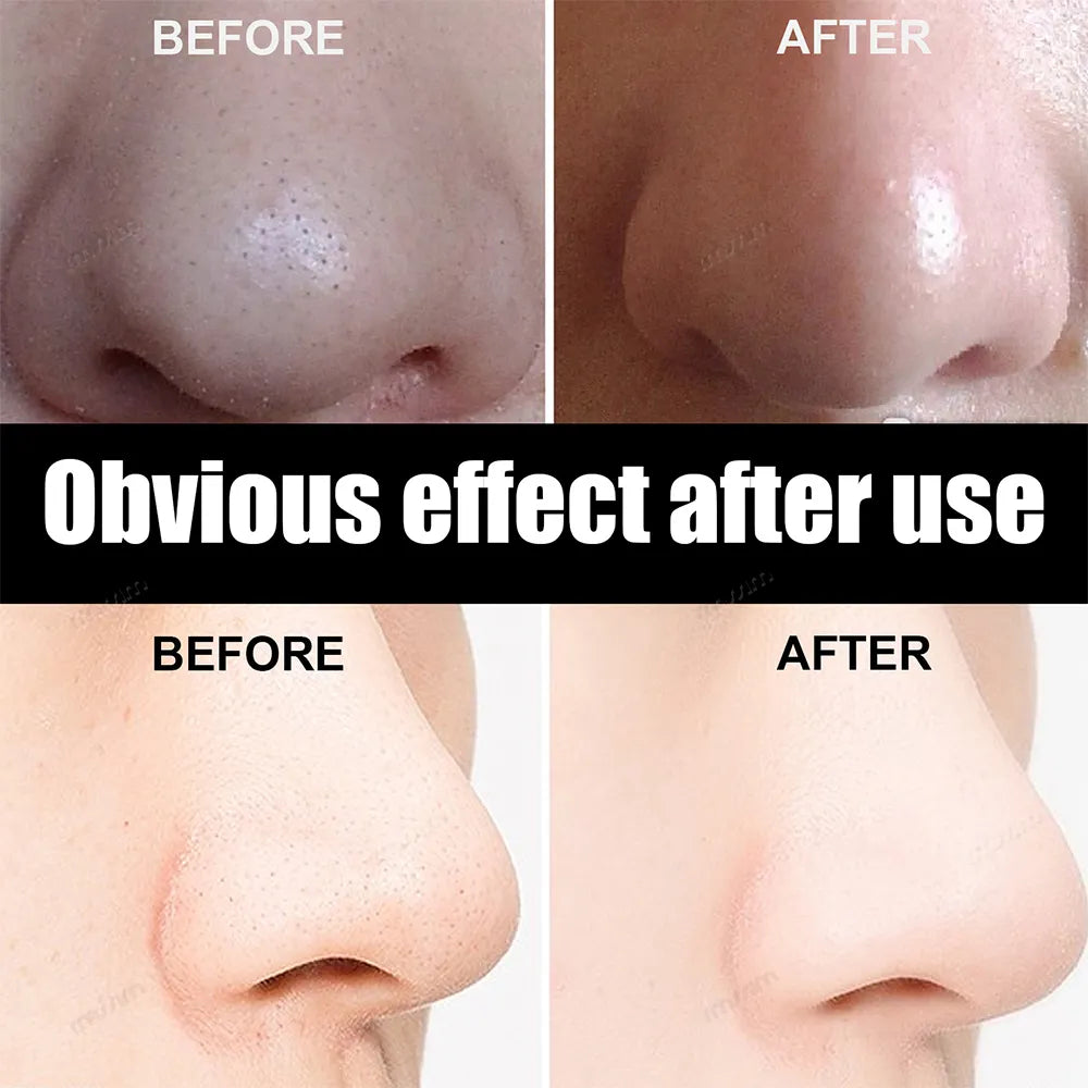 Blackhead Remover Nose Pore Strips